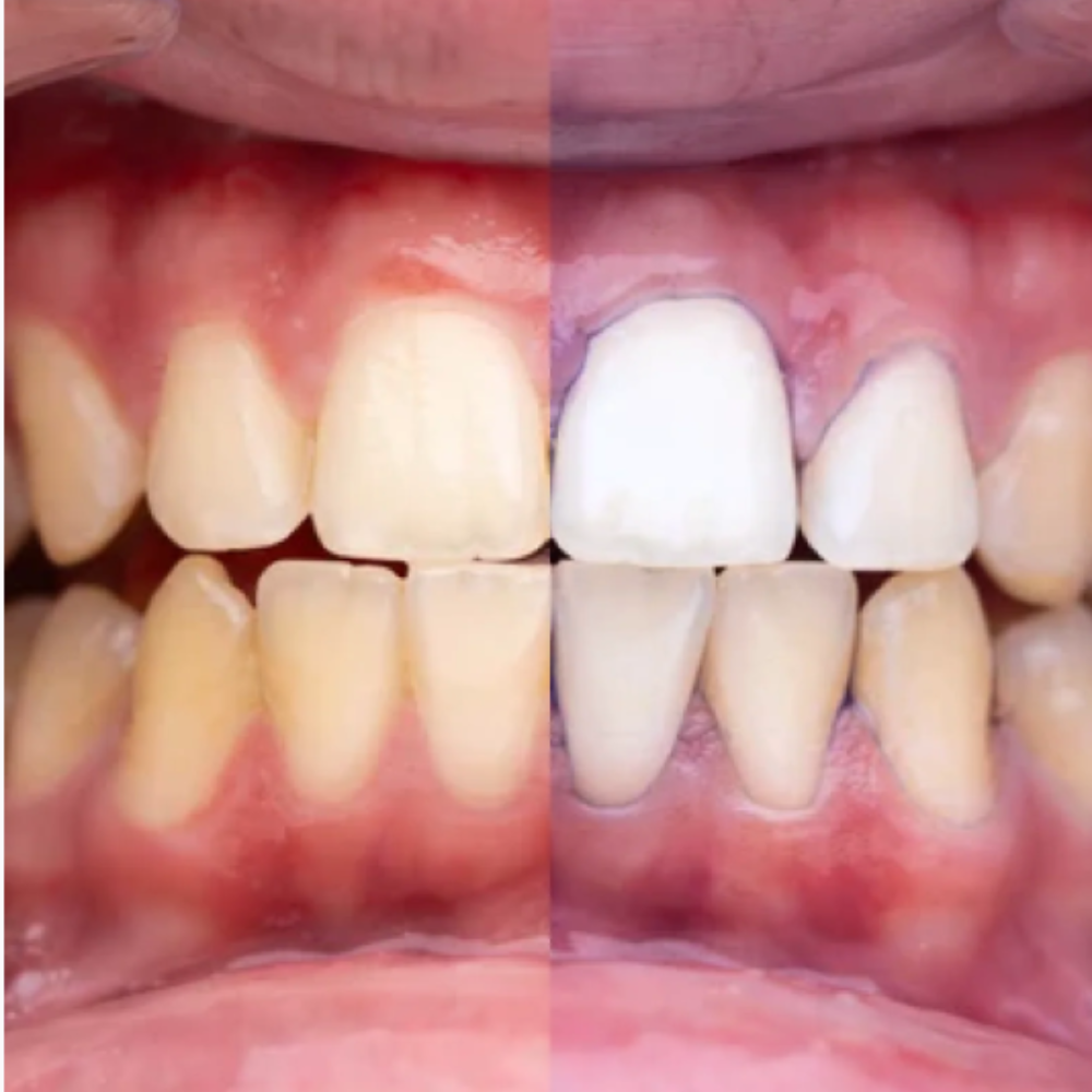 GlumiWhite™ - Blanqueador V34 - [PROMOCIÓN DISPONIBLE SOLO HOY]